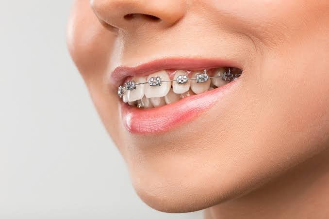Orthodontic Braces treatment