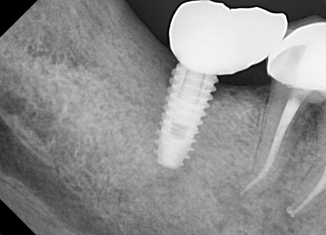 Dental Implant treatment