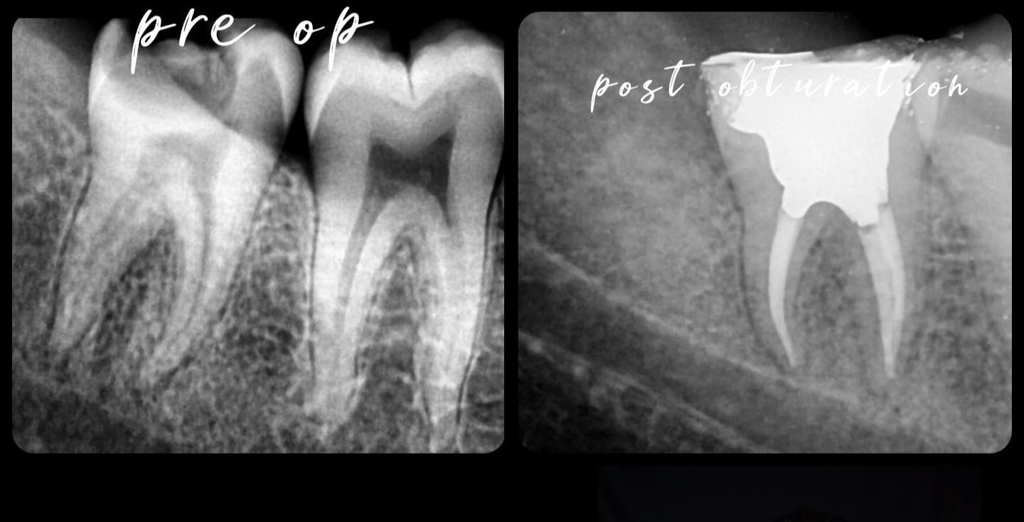 Root Canal Treatment