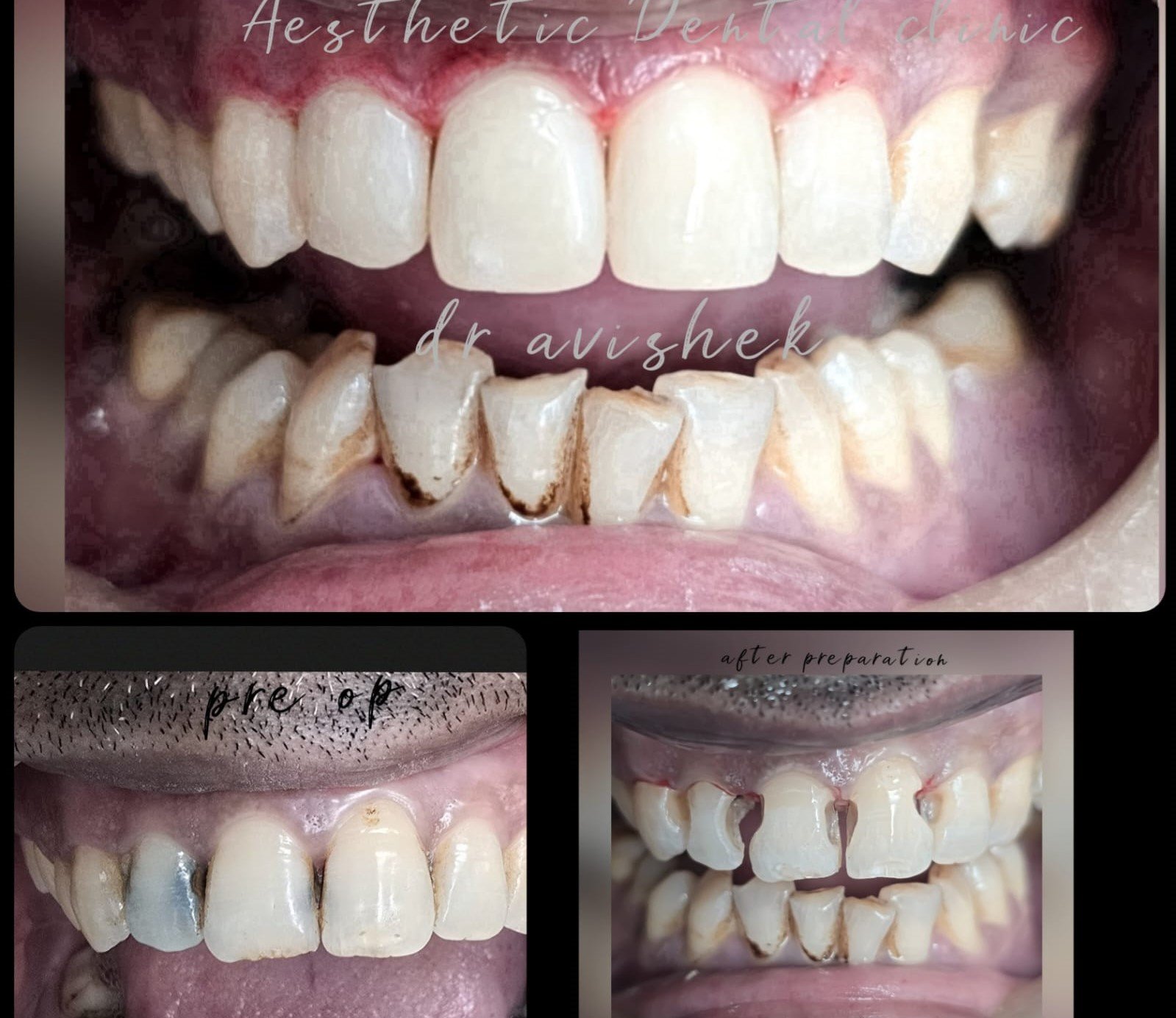 Smile Design and Makeover